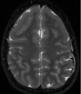 Fig 6. Lissencephaly. MR imaging (T2 FSE, axial plane) shows a  smooth brain surface with no sulci on the anterior region (agyria),  and a few shallow sulci posteriorly, with thick and broad gyri  (pachygyria).