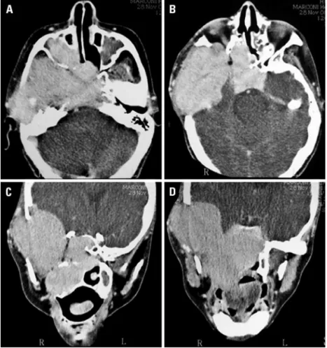 Fig 1. CT: [A and B] Contrast-enhanced axial, [C and D] Contrast-enhanced coro- coro-nal