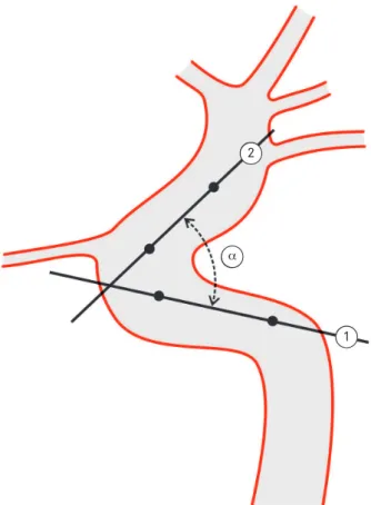 Fig 1. Carotid siphon angle (α) formed by the intersection of  two lines traced from intracavernous (1) and supraclinoid (2)  points through the artery.