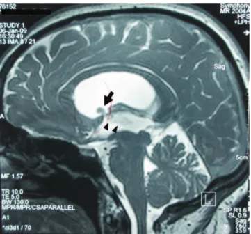 Fig 1. Brain magnetic resonance imaging sagittal T2-weighted  image showed an intraventricular cyst (arrow) extending to the  third ventricle (arrowheads).