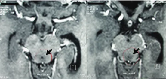 Fig 2. Contrast-enhanced axial T1-weighted image with edema around the cerebral aqueduct (arrows).
