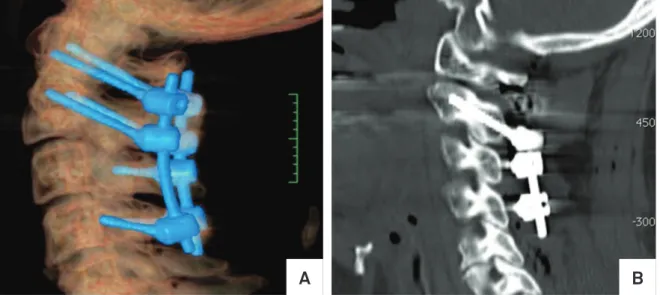 Fig 5. A C1-C4 stabilization for treatment of an odontoid pathological fracture. We use long bilateral C2 pedicular screws