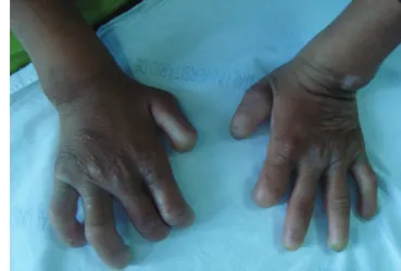 Fig 2. Acrodystrophy in hands.