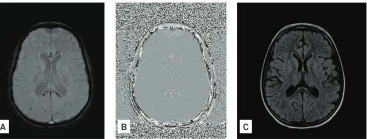 Fig 1. Susceptibility-weighted imaging (A) and phase images of susceptibility-weighted imaging (B) show multiple foci of low  signal intensity on genu and splenium of the corpus callosum and subcortical white matter on susceptibility-weighted imaging,  wit