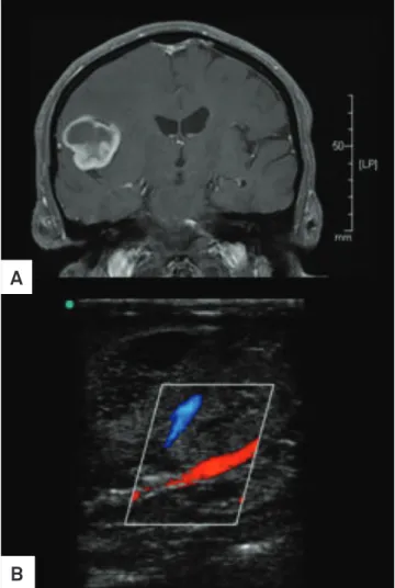 Fig 2. Case 10: Glioblastoma Multiforme. (A) Contrast  enhanced T1 MRI image; (B) IOUS showing middle cerebral  artery branch within tumor.