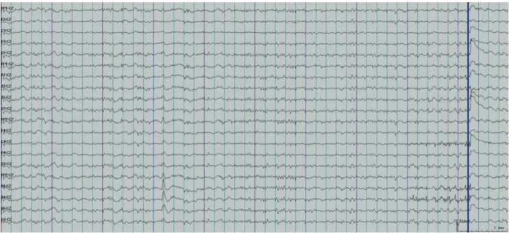 Fig 1. Electroencephalogram tracing showing slow-wave discharges of heightened aspect of projection in the right temporal region.
