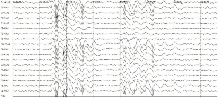 Fig 2. Electroencephalogram showing epileptiform discharges with generalized projection predominantly in the anterior regions.