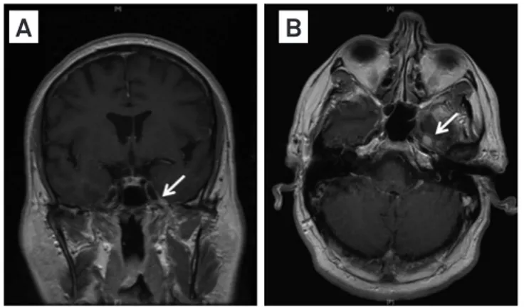 Fig 2. Computed tomography of the chest, abdomen, and pelvis  with contrast, axial (A), and coronal reconstruction (B) shows  an exophytic peripheral enhancing mass (arrow) arising from  the posterior interpolar aspect of the left kidney.