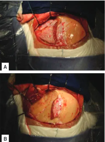 Fig 2. Incisions and detachment of the temporalis muscle: (A)  vertical muscle incision performed perpendicularly to the zygoma  for the interfacial dissection and transverse incision parallel to the  superior temporal line, leaving a superior strap of the