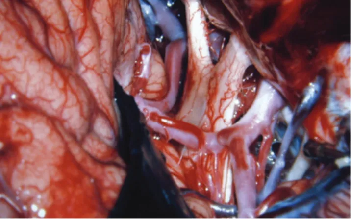 Fig 7. The carotid cistern, the chiasmatic cistern, the  sphenoid compartment of the sylvian fissure and the  lamina terminalis cistern.