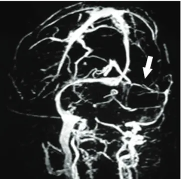 Fig 1. Magnetic ressonance venography showing narrowed  lumen of the left transverse sinus (arrow).