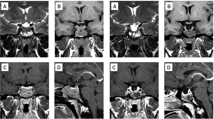 Fig 1. T2- and T1-W pre-contrast coronal images (A and B)  demonstrate a heterogeneous mass lesion containing cystic  areas involving the clivus and sphenoidal sinus; post-contrast  T1-W coronal (C) and sagittal images (D) show a homogeneous  enhancement o