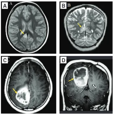 Fig 1. (A) Axial proton density: a small well circumscribed lesion  in the right cingulus; (B) Coronal T2: a small lesion in the right  cingulus, with high signal intensity in the mass