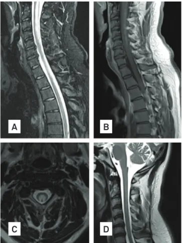 Fig. Spinal cord MRI: (A) extensive swelling of spinal cord,  caused by vacuolization of myelin; (B) subtle contrast  enhancement of posterior column; (C) cross-section images  of spinal cord MRI: bilateral paired areas of hyperintensity  affecting dorsal 