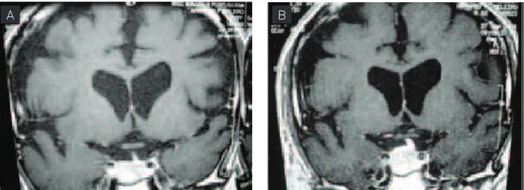 Fig 2. After radiosurgery. (A) Image from June, 2004 (three months after radiosurgery); (B) image from September, 2004 (six months  after radiosurgery), both showing growth of the sellar lesion.