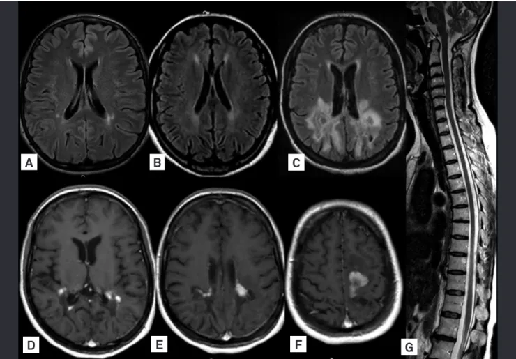 Fig 2. Severe periventricular demyelination with enhancement after contrast. This patient was misdiagnosed as childhood form of  multiple sclerosis.
