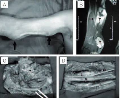 Fig 1. Case 1. (A) Two masses in the medial surface of the right arm (arrows), one immediately proximal to the elbow and the other  about 5 cm proximal and apart to the first one