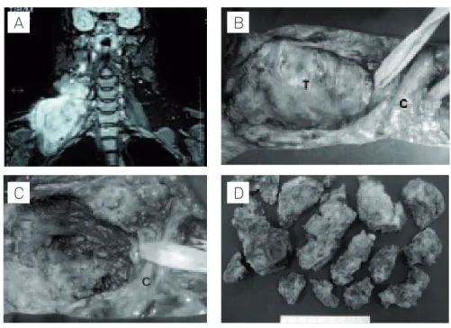 Fig 2. Case 3. (A) RM, Coronal T2-weighted MR image, with fat-supression, demonstrating a large mass with high signal intensity  in the supraclavicular region, involving/dislocating the brachial plexus