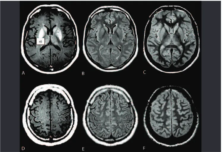 Fig 2. Asymmetric ALS (32-year-old man). (A) A small, ovoid hyperintensity in the CST in the right internal capsule (arrow) is only  noticed on axial T1 SE MTC