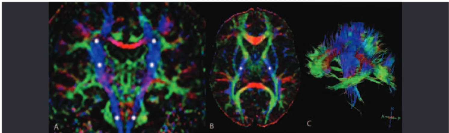 Fig 3. Corticospinal tracts on DTI. (A) Coronal DTI color map clearly demonstrates the CST (asterisks)