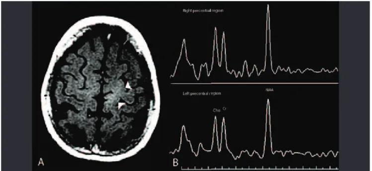 Fig 4. Primary lateral sclerosis (61-year-old woman). (A) Axial T1 SE MTC shows asymmetric abnormal hyperintensity in the  left subcortical precentral region, which extends to the paracentral lobule