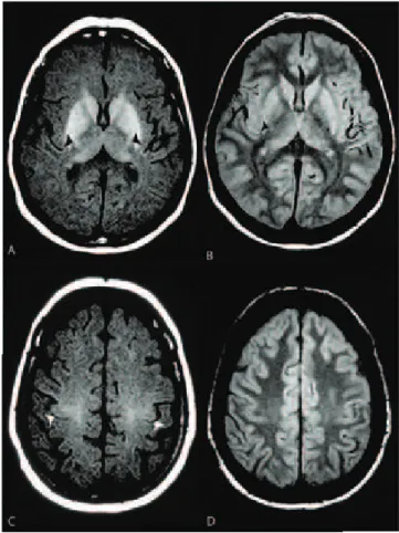 Fig 5. Comparative MRI sequences in ALS (56-year-old  woman). Comparative analysis of the CST in the internal  capsules shows symmetric abnormal ovoid foci with  hyperintensity on axial T1 SE MTC (A)