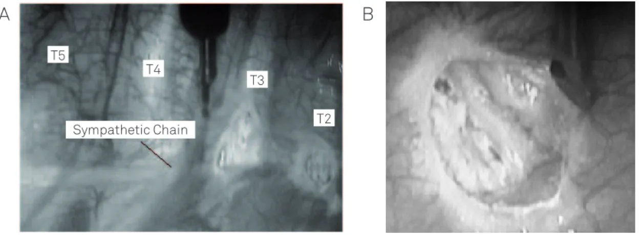 Fig 2. Chart comparing the outcomes observed 36 months  following VATS regarding palmar and axillar hyperhidrosis on  the left and the right side.