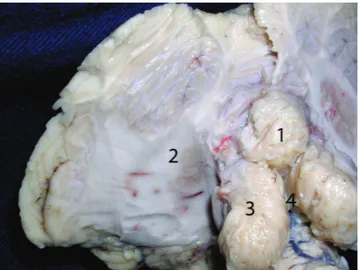 Fig 2. Basal surface of the cerebellum. The left and right  cerebellar hemispheres have been removed to expose the  dentate nucleus and its relationship with the tonsils