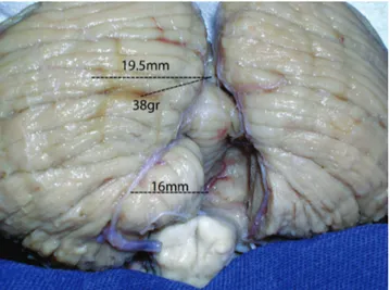 Fig 4. Suboccipital surface view of the cerebellum. Notice that  the distance from the middle line to the lateral border of the  dentate nucleus is 19.5 mm and 38º is the angle of separation  from the middle line to avoid the dentate nucleus during the  su