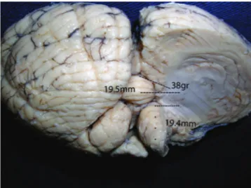 Fig 6. The right cerebellar hemisphere has been sectioned  to show the different relationships of the dentate nucleus to  the nearby structures