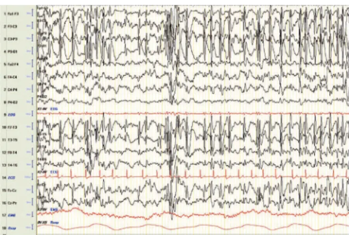Fig 2. NREM sleep EEG. Epileptiform activity in the left  hemisphere: continuous spike-wave greater than 85%
