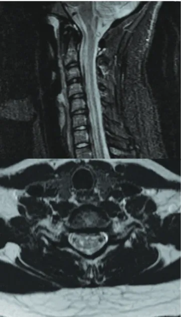 Fig 1. Magnetic resonance imaging showing slight asymmetric  T2-weighted hypersignals on the central H region of spinal  cord extending from C5 to C7.