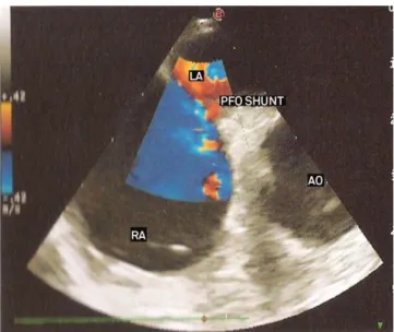 Fig 2. Transesophageal ecocardiography showing patent  foramen ovale with paradoxical interatrial shunt.