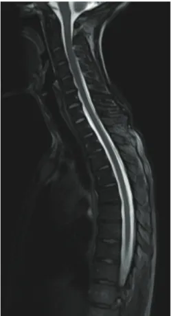 Fig 2. Spinal MRI five months after epidural blood patch,  revealing no imagiological improvement.