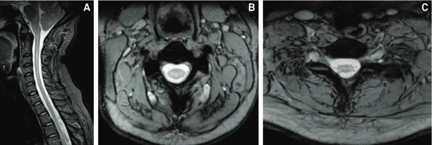 Fig 2. Cervical spinal cord MRI findings in HTLV-1 infection. (A) Sagittal STIR and (B) axial T2* GRE (at the level of C3) demonstrate  extensive high signal intensity from C2 to the level of the dorsal spinal cord, predominating on the posterior region of
