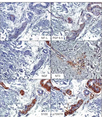 Fig 1. Immunohistochemical expression of NF-L, PGP 9.5, NGF,  NT3, S100 and p75 NTR  in Remak bundles of leprosy patient (LL).