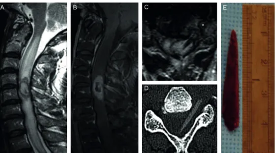 Fig. Preoperative magnetic resonance image and computed tomography. (A) MR Sagittal T2