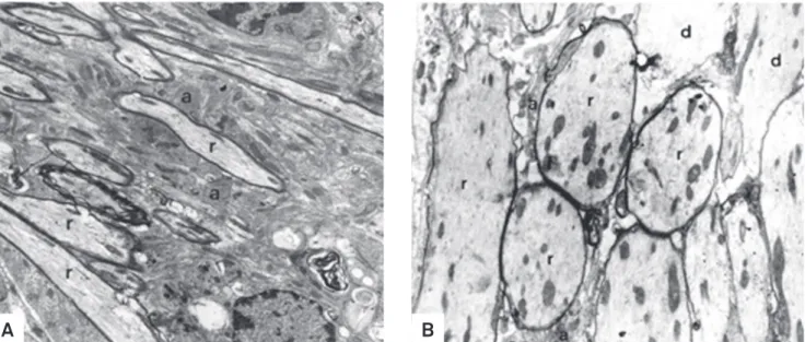 Fig 3. Oligodendrocyte-remyelinated areas in non-diabetic (A, group III) and diabetic (B, group I) rats at peripheral sites after ethidium  bromide injection