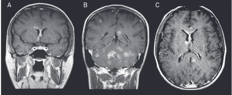 Fig 1. Case 2: Coronal T1 post-contrast (A and B) and axial T1 post-contrast (C) showing multiple and deep, cortical, and  subcortical lesions that reach the genu of the corpus callosum