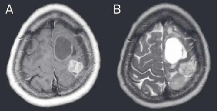Fig 3. Case 7: Axial T1-weighted image after contrast (A)  showing intra-axial lesion in the left superior frontal gyrus,  with peripheral contrast enhancement