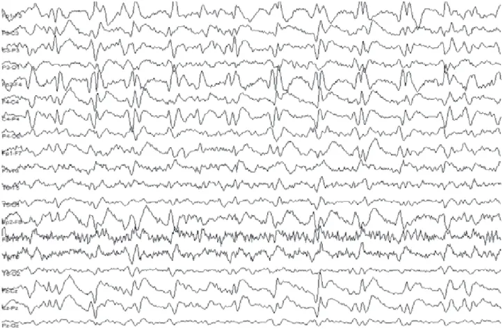 Fig 1. Generalized periodic discharges (GPEDs) in an EEG of a 72-year-old woman with epilepsy, presenting an altered mental  status due to nonconvulsive status epilepticus.