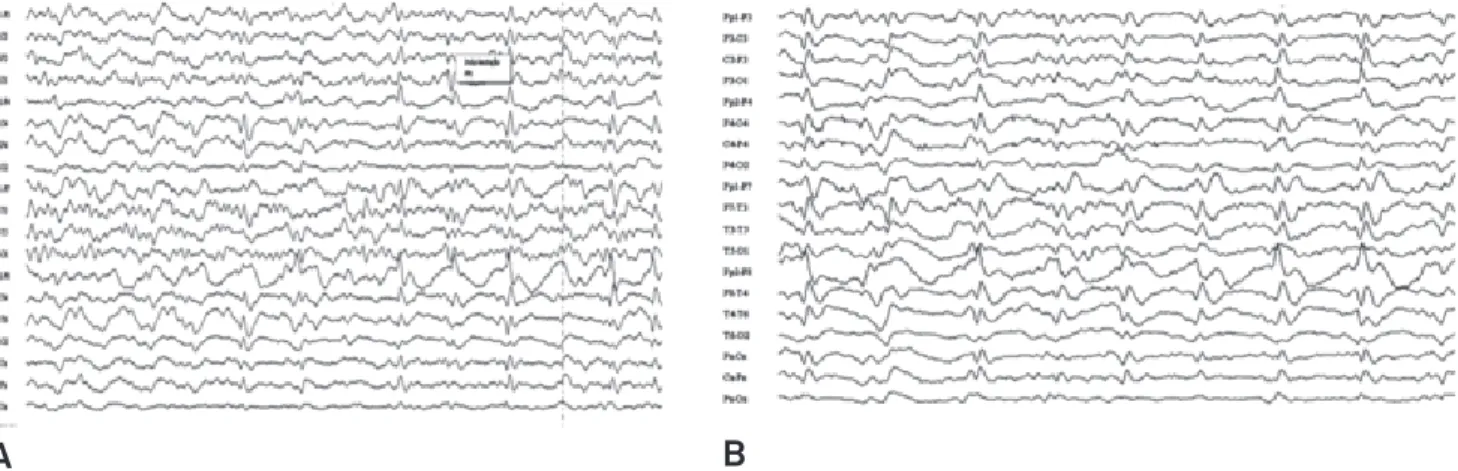 Fig 3. Pseudoperiodic runs of triphasic sharp waves in a background generalized slowing EEG