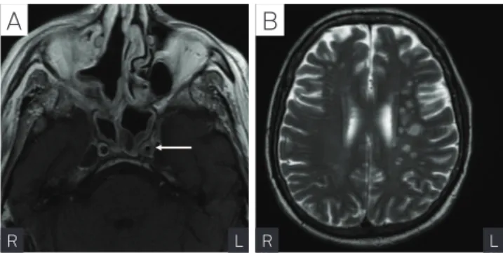 Fig. Brain magnetic resonance image. (A) Axial T1-weighted  image with contrast – uptake at both cavernous sinus and  internal carotid wall (arrow) that determine an arterial lumen  stenosis in the left side
