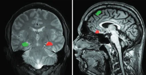 Table 2. Results obtained in the analysis of the left hippocampus in the MRI. The table shows the texture parameters that  presented statistically significant differences between the group of patients and the control group