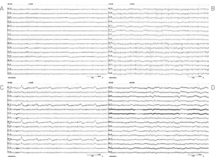 Figure 1. Examples of the EEG classifications in patients with acute encephalopathy 10 