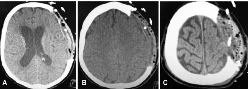 Figure 2. Axial brain CT one day after methyl methacrylate cranioplasty of the trephined patient from Figure 1