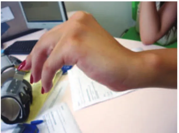 Figure 1. Wrist extension partially preserved and deviation of  the hand to the radial side
