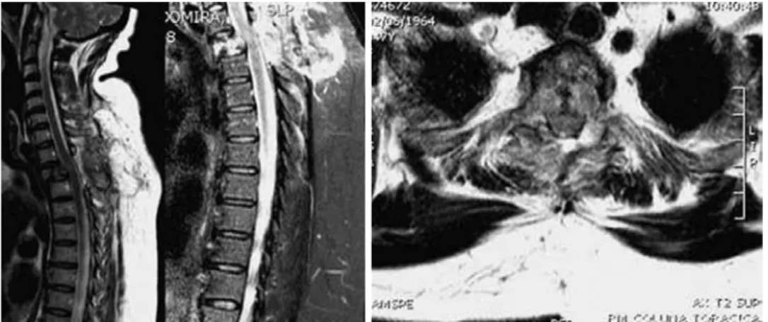 Figure 1. Left: MRI images of a 47-year-old female patient with no previous oncological history who presented with acute paraparesis  and a pathologic fracture of T3 with anterior spondylolisthesis causing spinal cord instability and compression