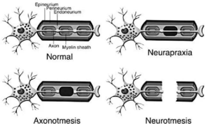 Figure 1. Schematic drawing of a normal nerve fiber and  the three grades of nerve injury according to Seddon’s  classification.