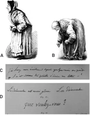 Figure 2. Parkinson’s disease: A-B, postures; C-D, micrograph  and tremor (source: Oeuvres complètes by Charcot 7 ).